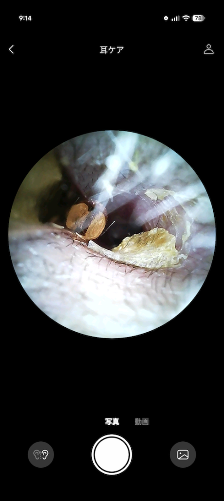 Bebird EarSight Ultra X アプリで見た耳の中